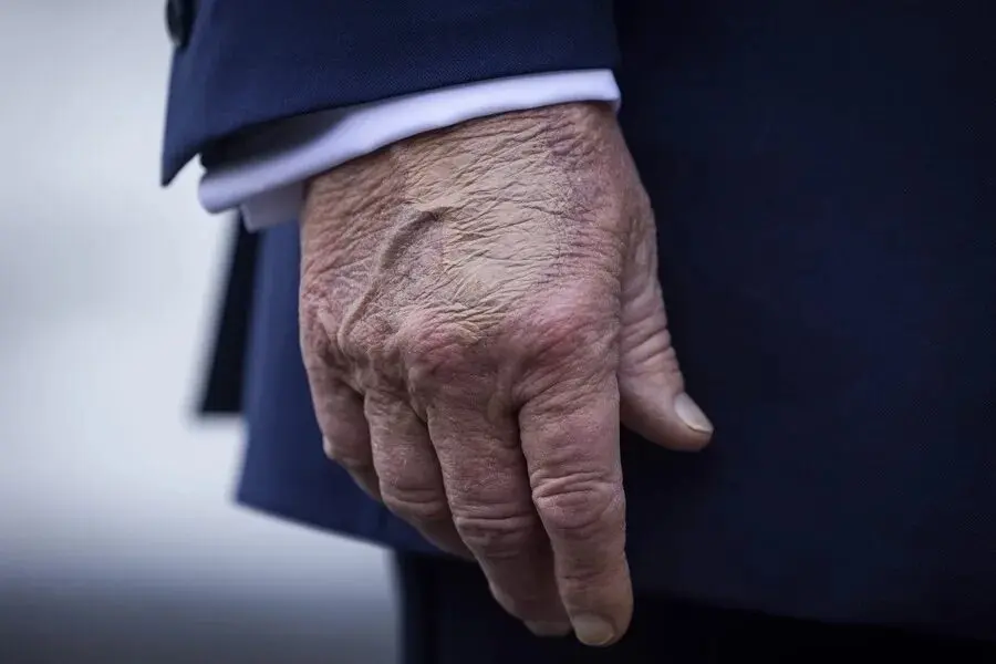 What’s Behind Trump’s Bruised Hands? White House Confirms Chronic Venous Condition