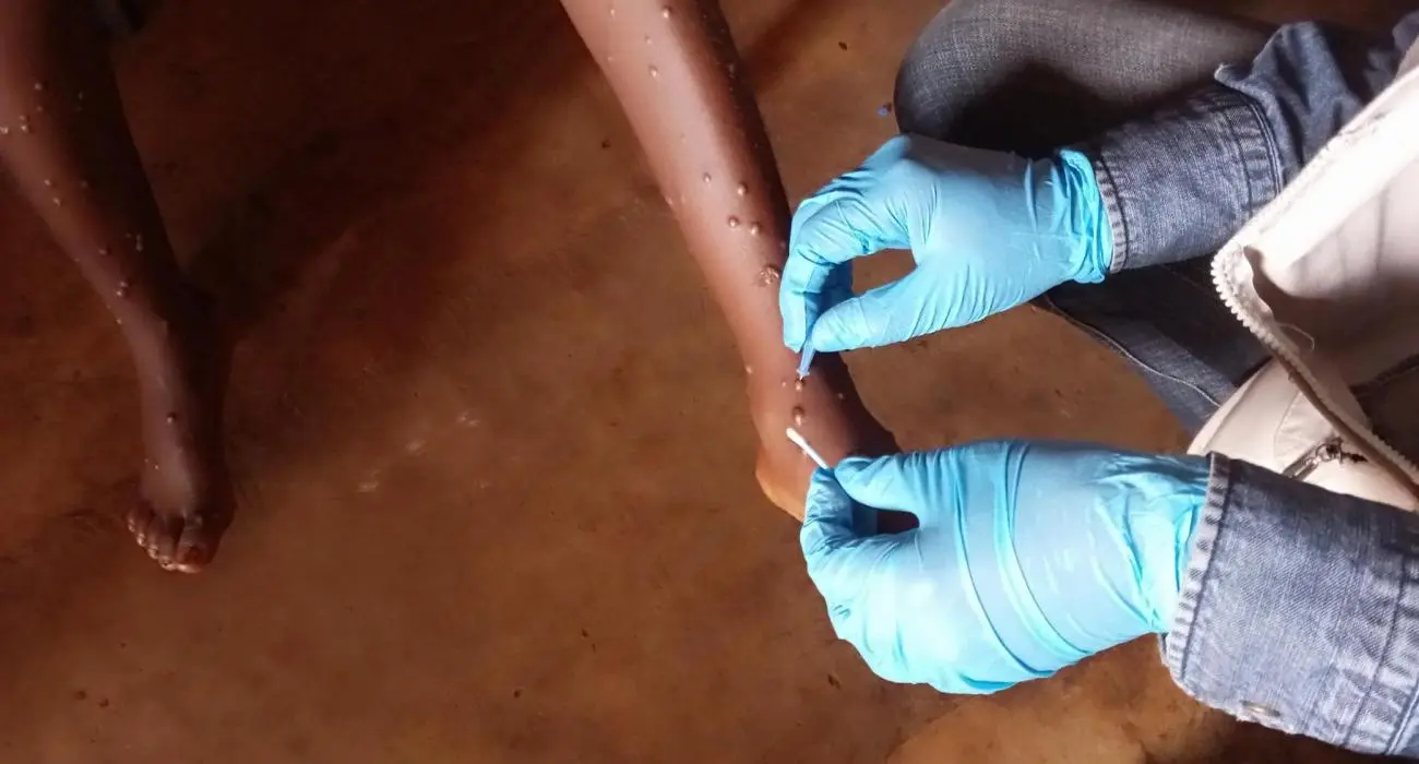 Africa: Over 8,000 Lives Lost to Cholera and Mpox in 2025